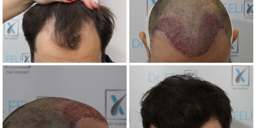 transplantul de par dr felix